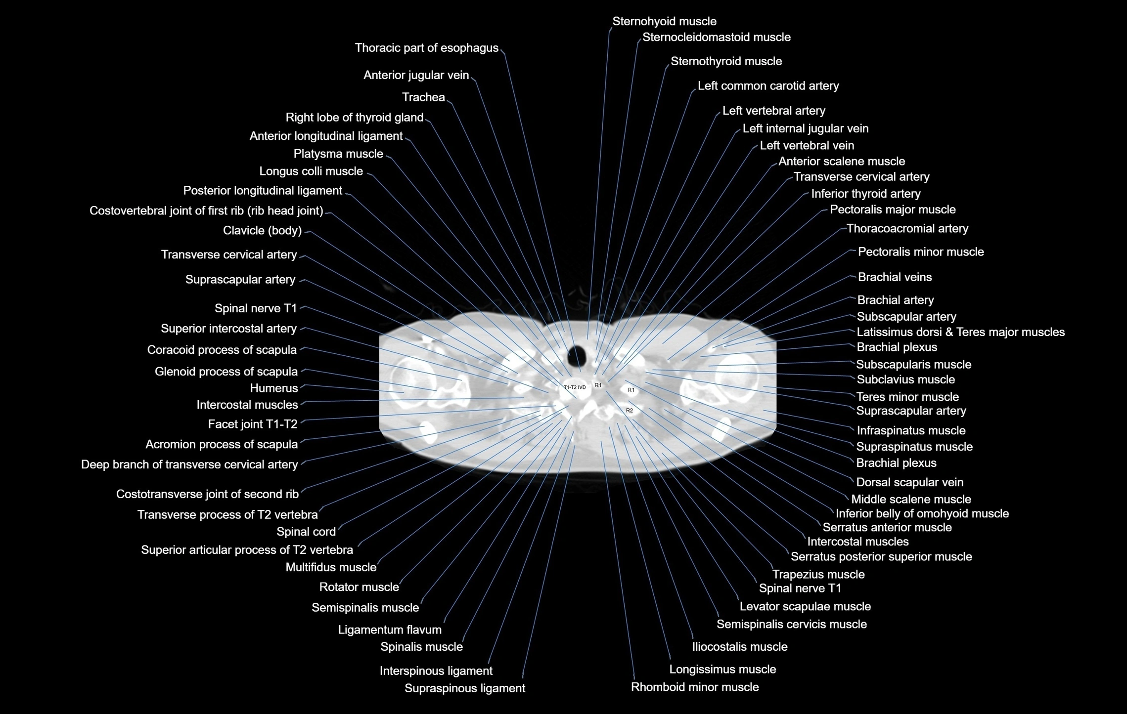 CT chest (thorax) labelled axial cross sectional anatomy radiology image-00005.webp